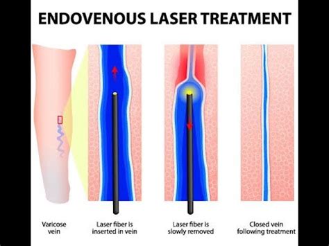 Clinica Alanya tratează varicele cu un laser